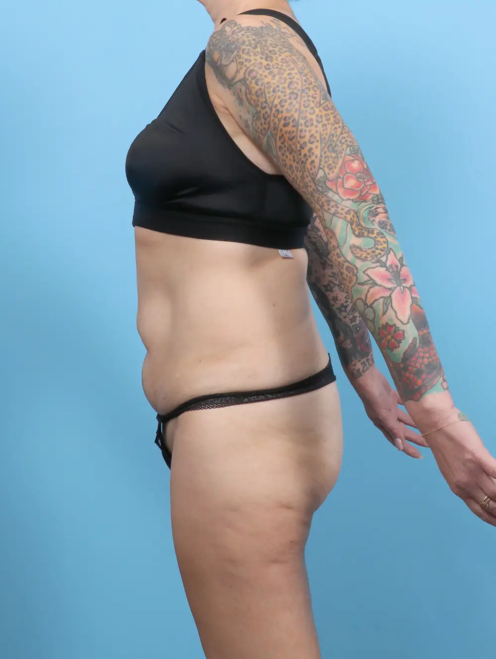 Tummy Tuck Patient Photo - Case 56570 - before view-2
