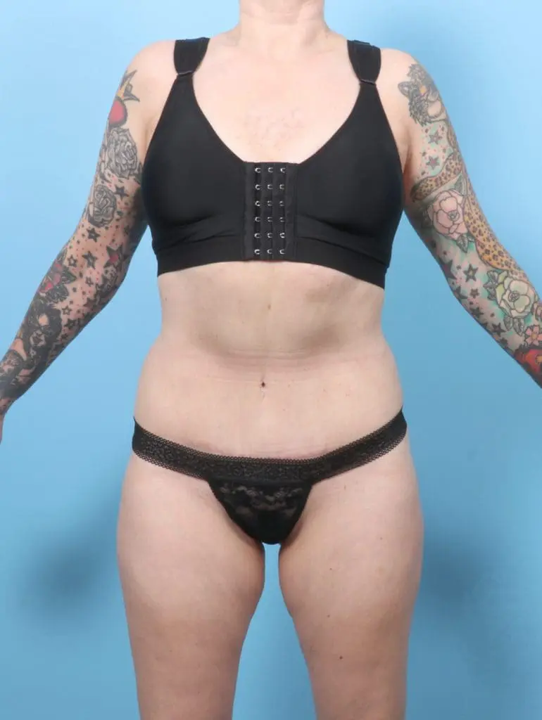 Tummy Tuck - Case 56570 - After