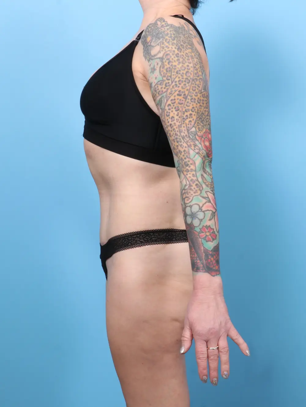 Tummy Tuck Patient Photo - Case 56570 - after view-2