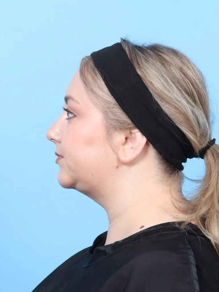 Liposuction - Case 56589 - After