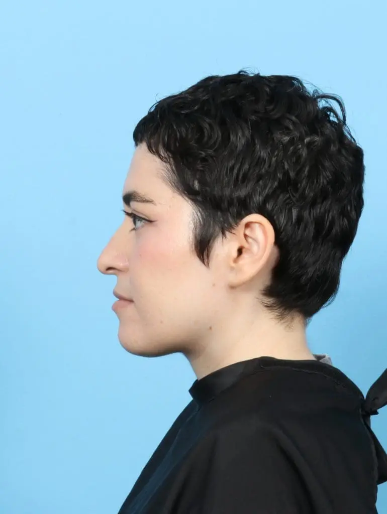 Rhinoplasty - Case 56597 - Before