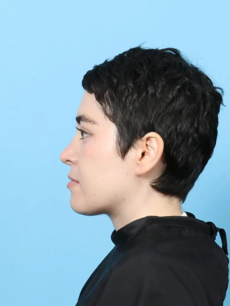 Rhinoplasty - Case 56597 - After