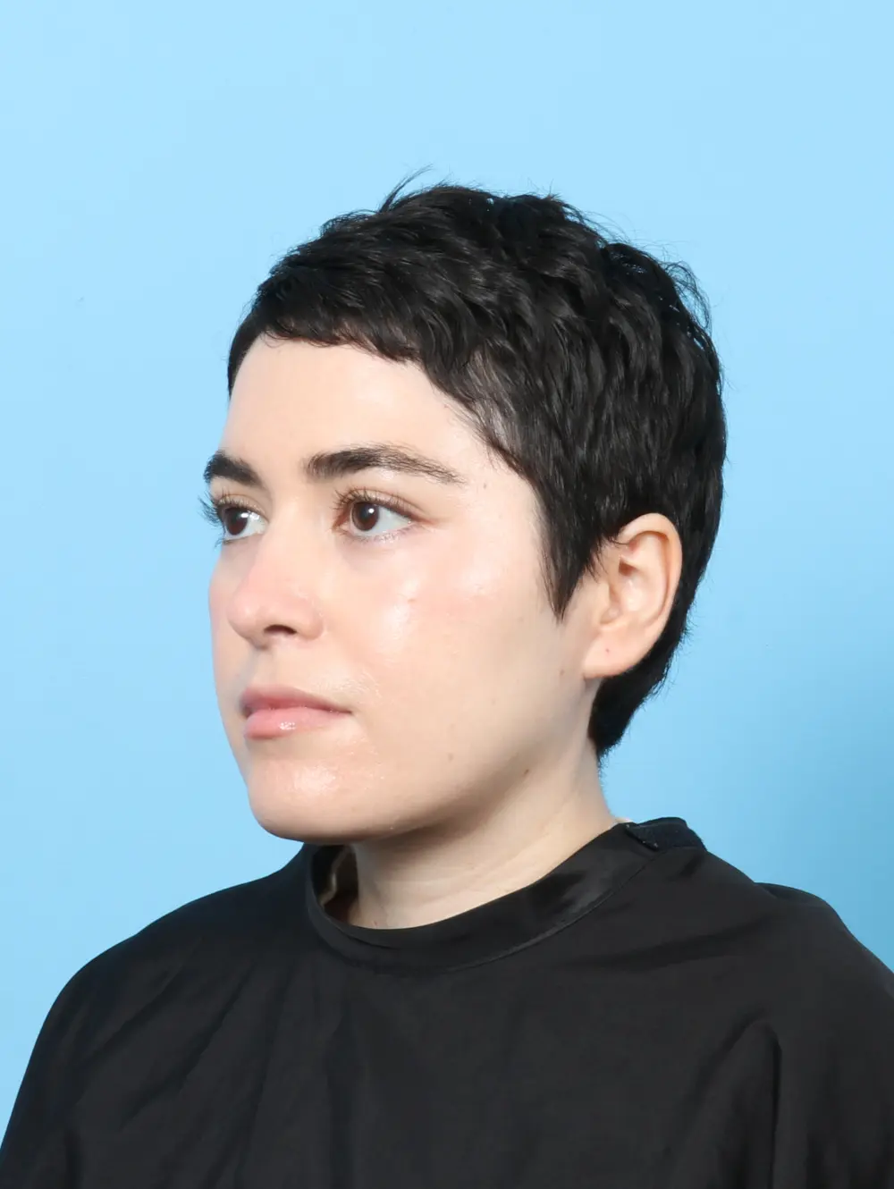 Rhinoplasty Patient Photo - Case 56597 - after view-1