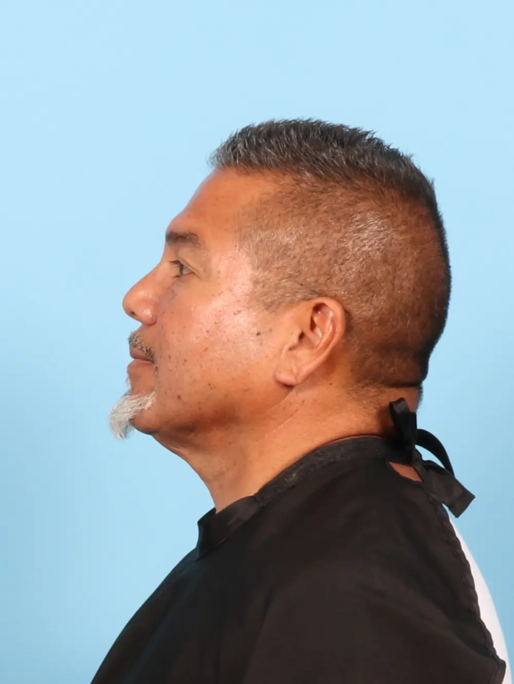 Eyelid Surgery Patient Photo - Case 56605 - before view-2