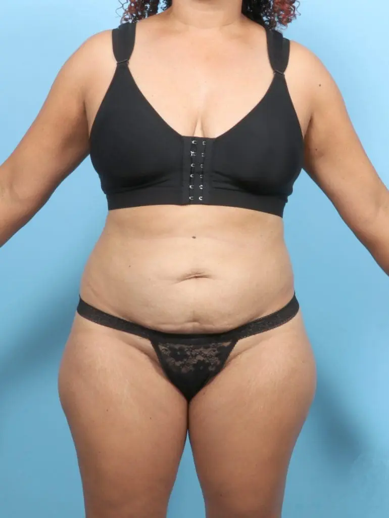 Tummy Tuck - Case 56638 - Before