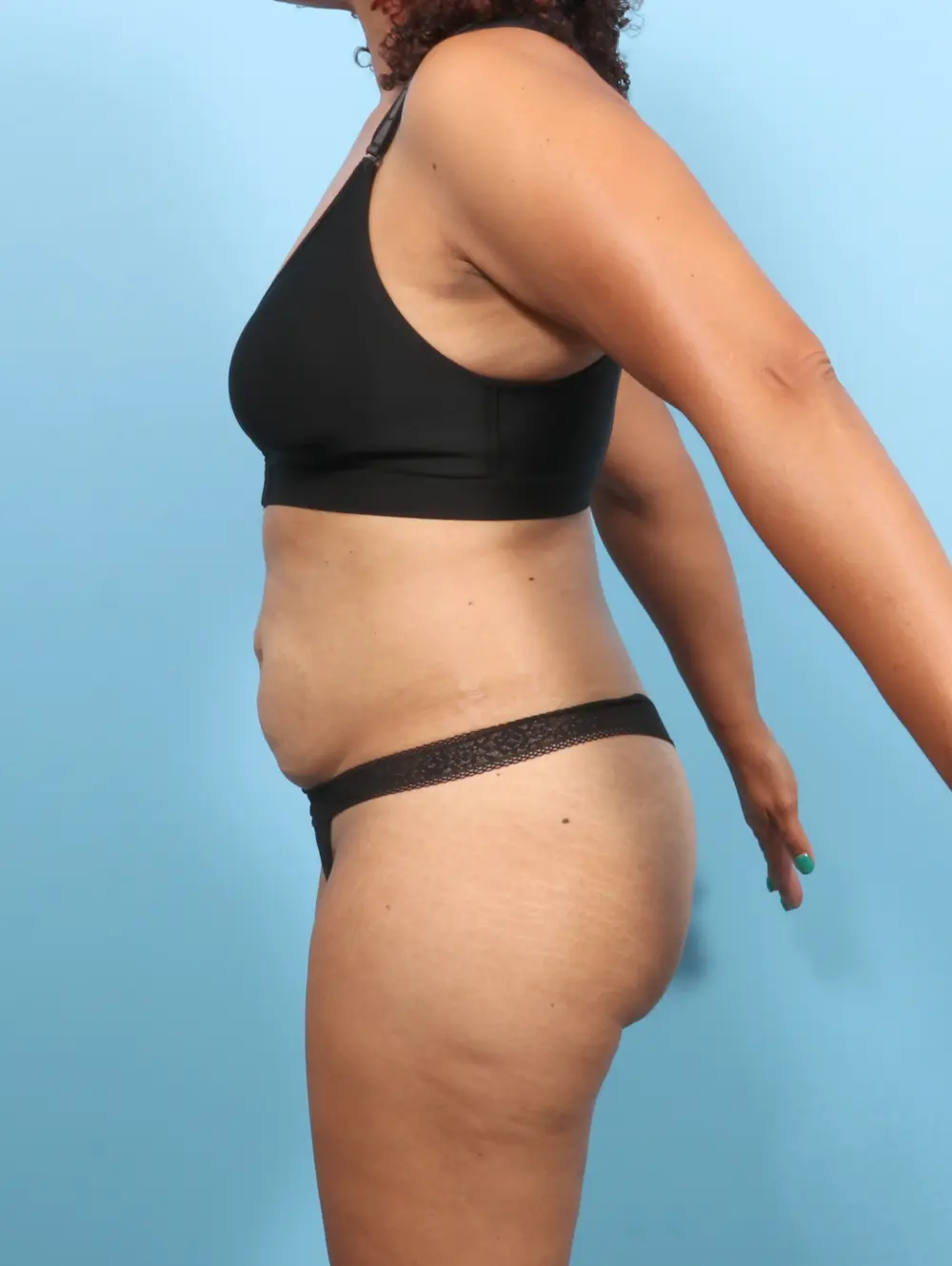 Tummy Tuck Patient Photo - Case 56638 - before view-2