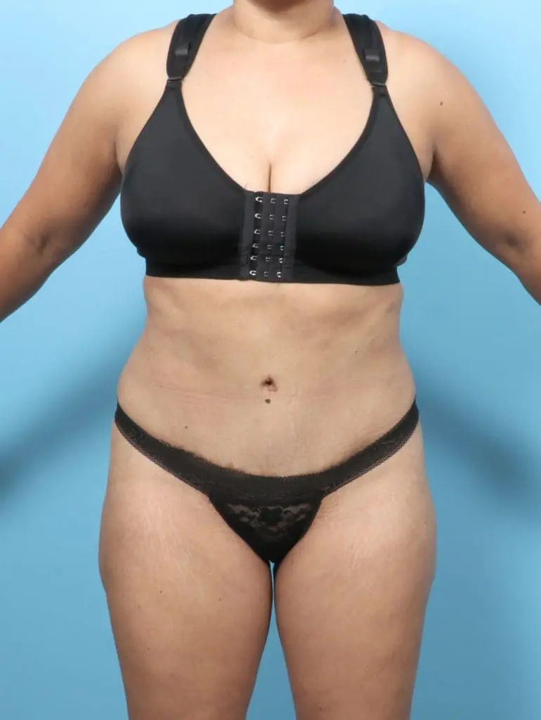 Tummy Tuck - Case 56638 - After