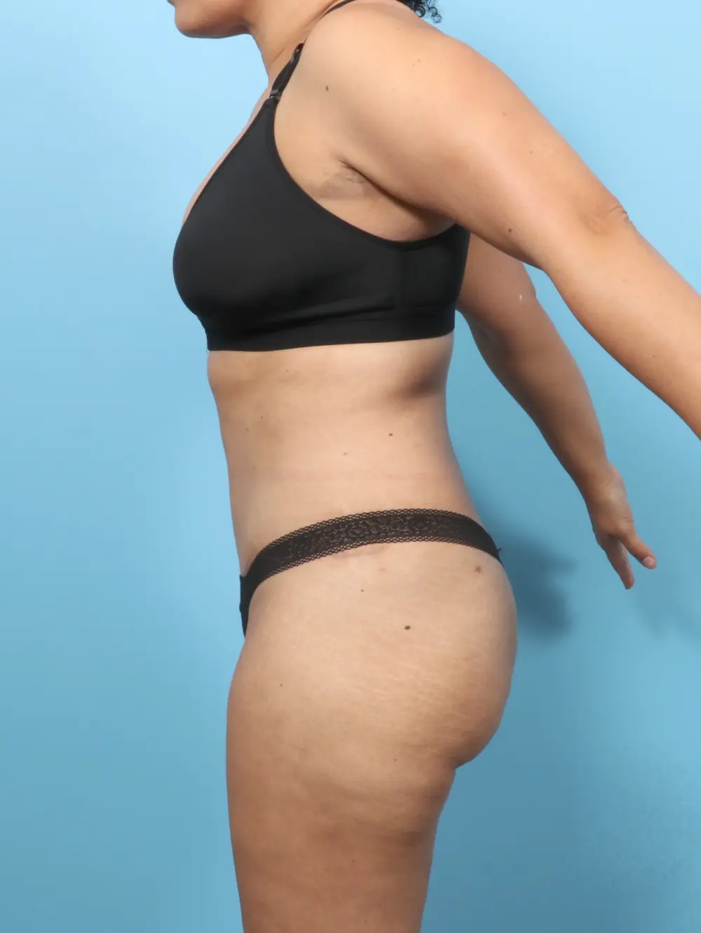 Tummy Tuck Patient Photo - Case 56638 - after view-2