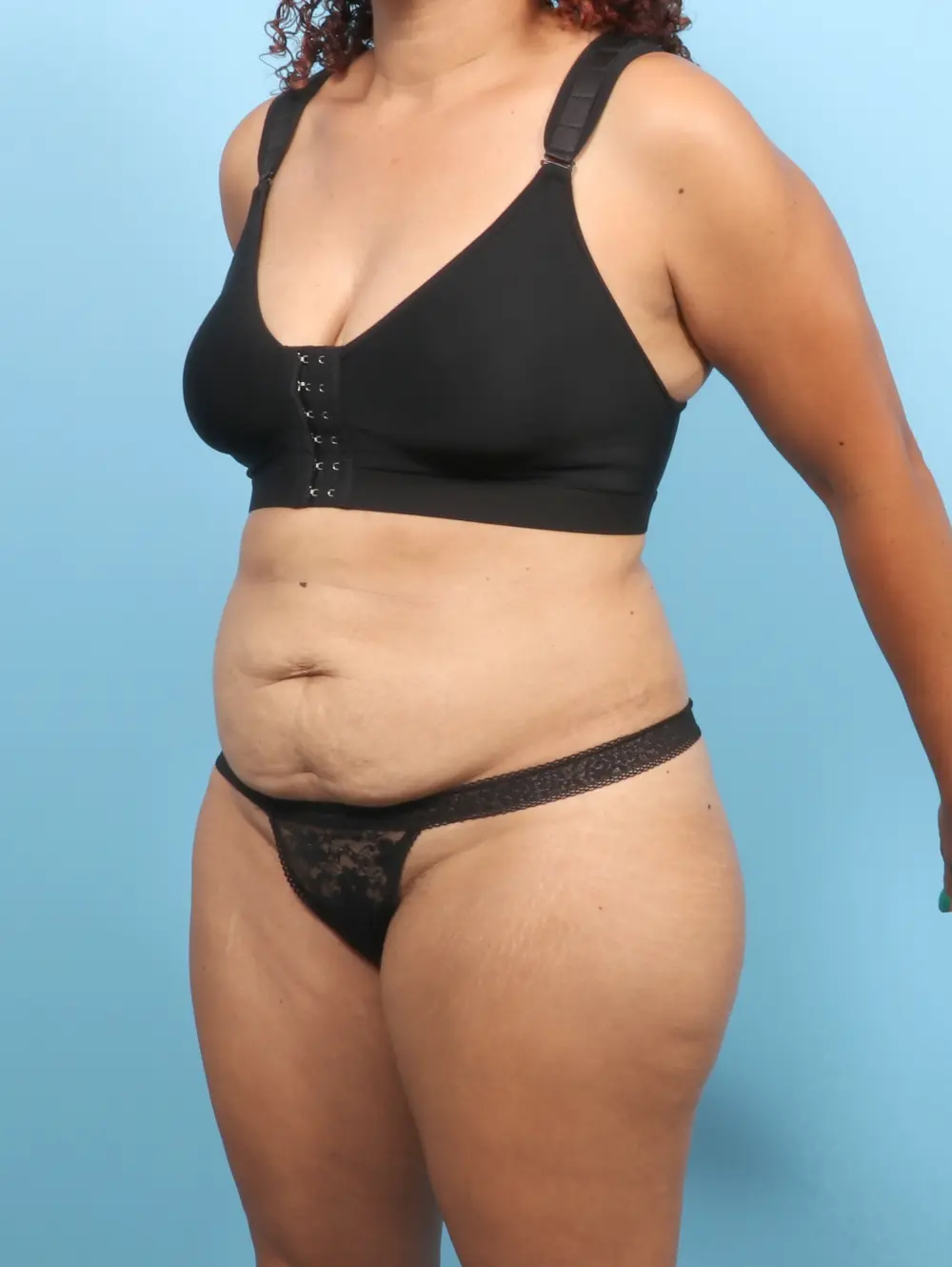 Tummy Tuck Patient Photo - Case 56638 - before view-1