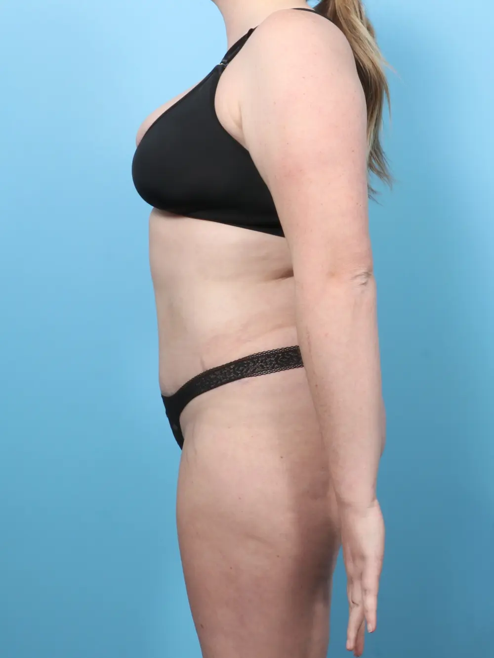 Tummy Tuck Patient Photo - Case 56646 - after view-2