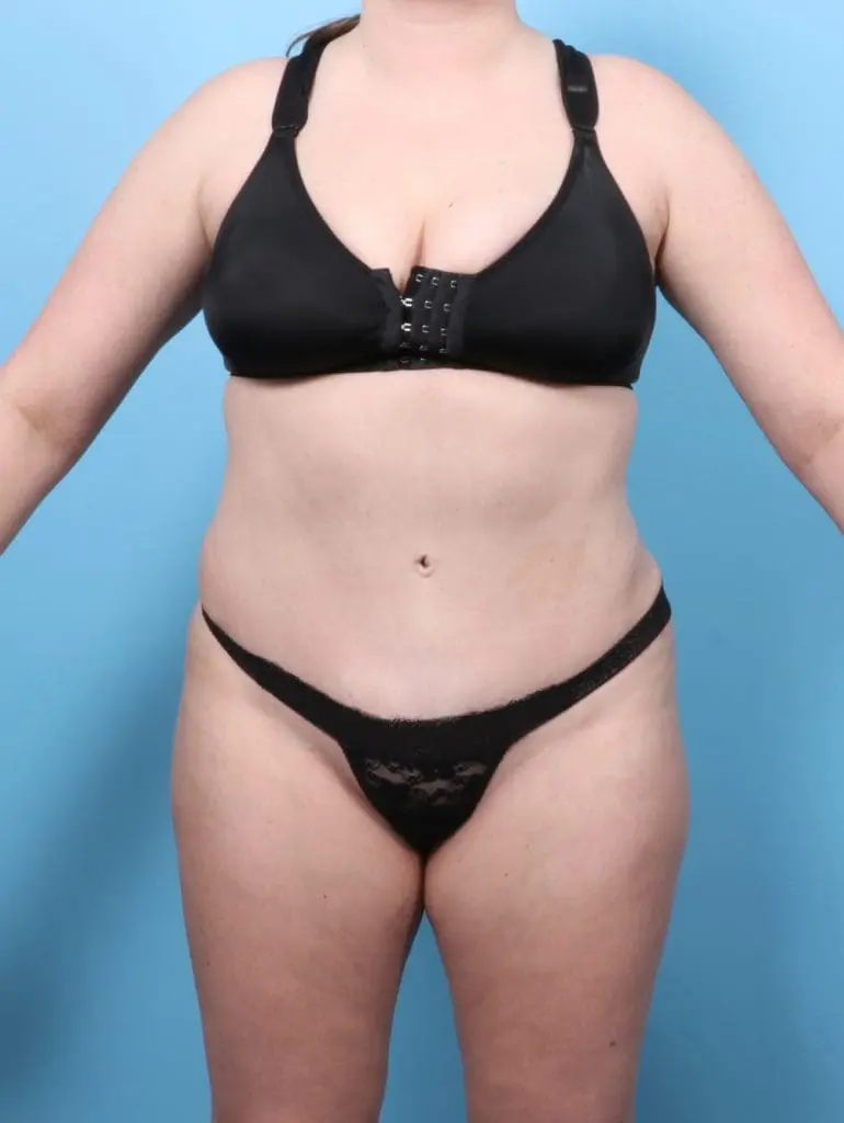 Tummy Tuck - Case 56646 - After