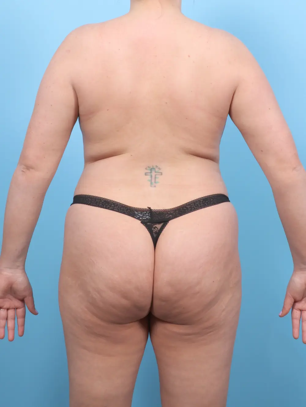 Tummy Tuck Patient Photo - Case 56646 - before view-3