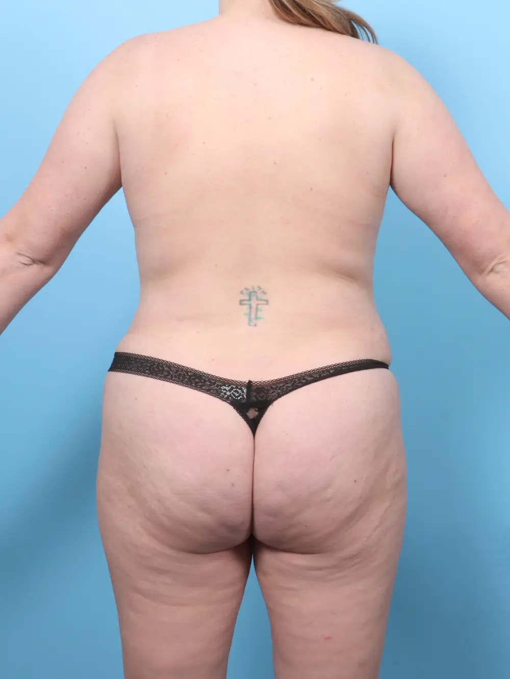 Tummy Tuck Patient Photo - Case 56646 - after view-3