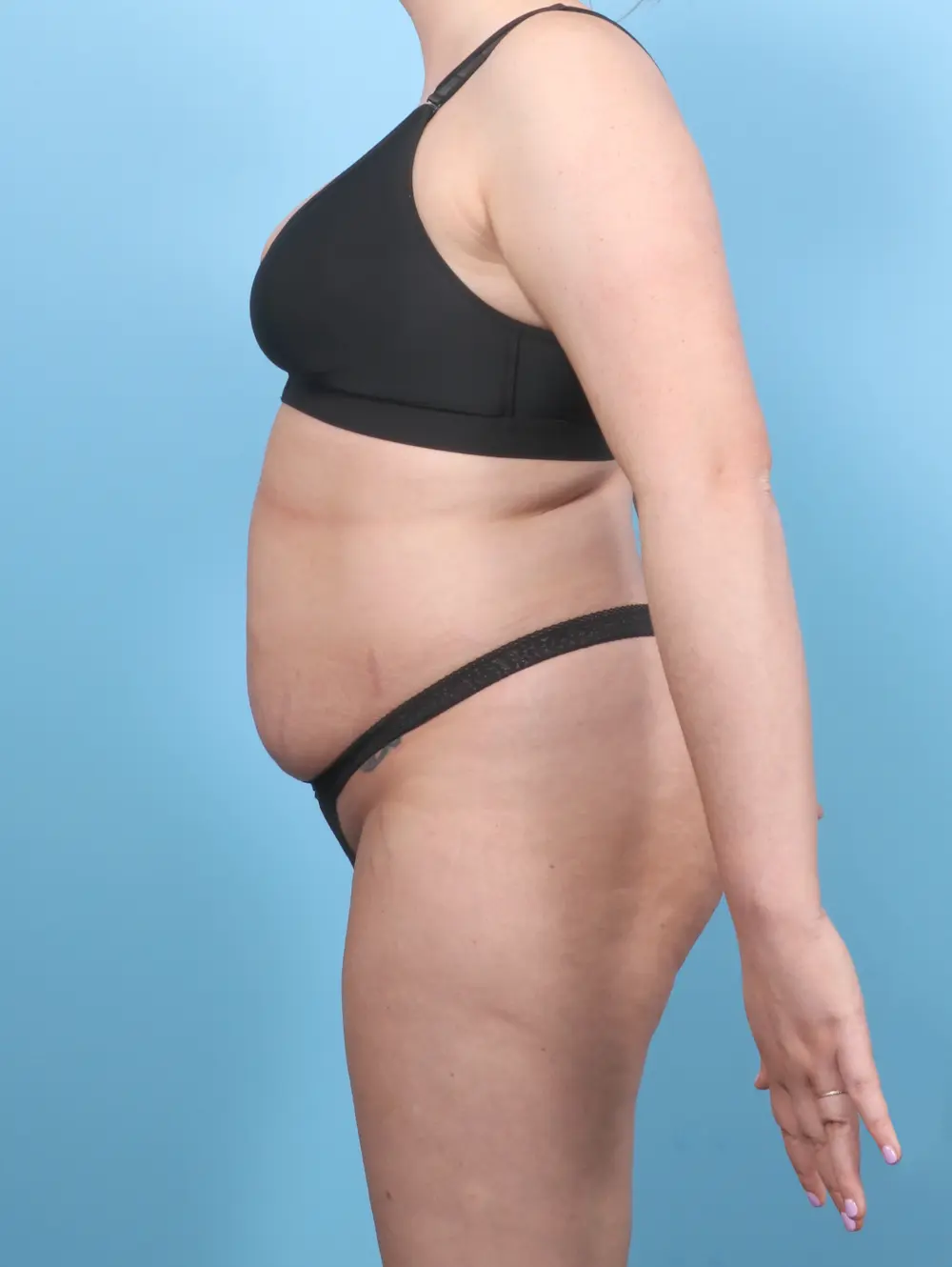 Tummy Tuck Patient Photo - Case 56646 - before view-2