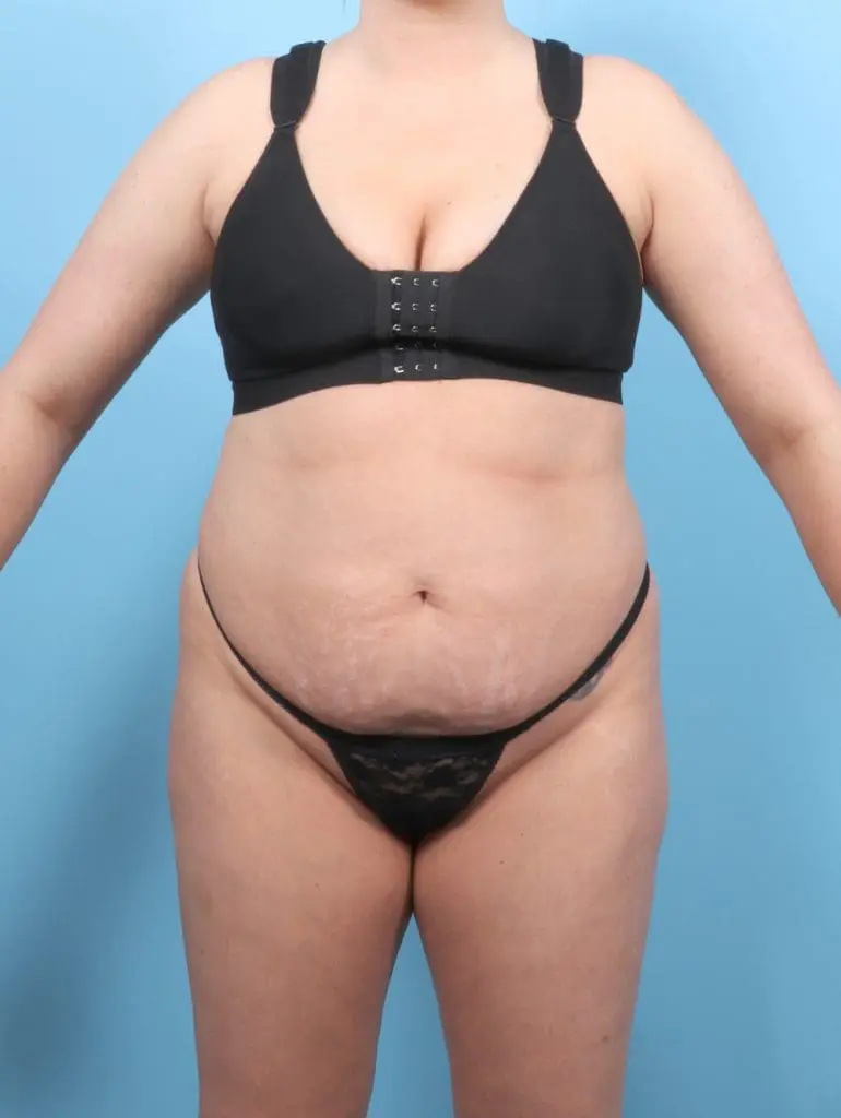Tummy Tuck - Case 56646 - Before