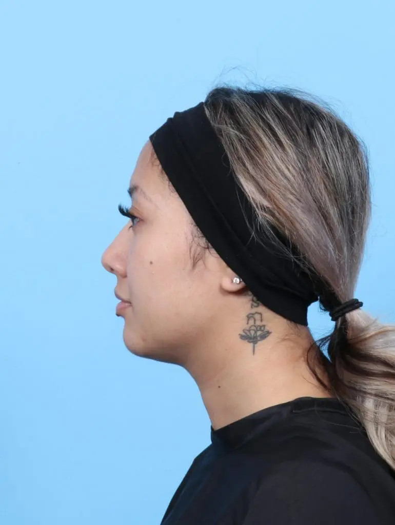 Rhinoplasty - Case 56656 - Before