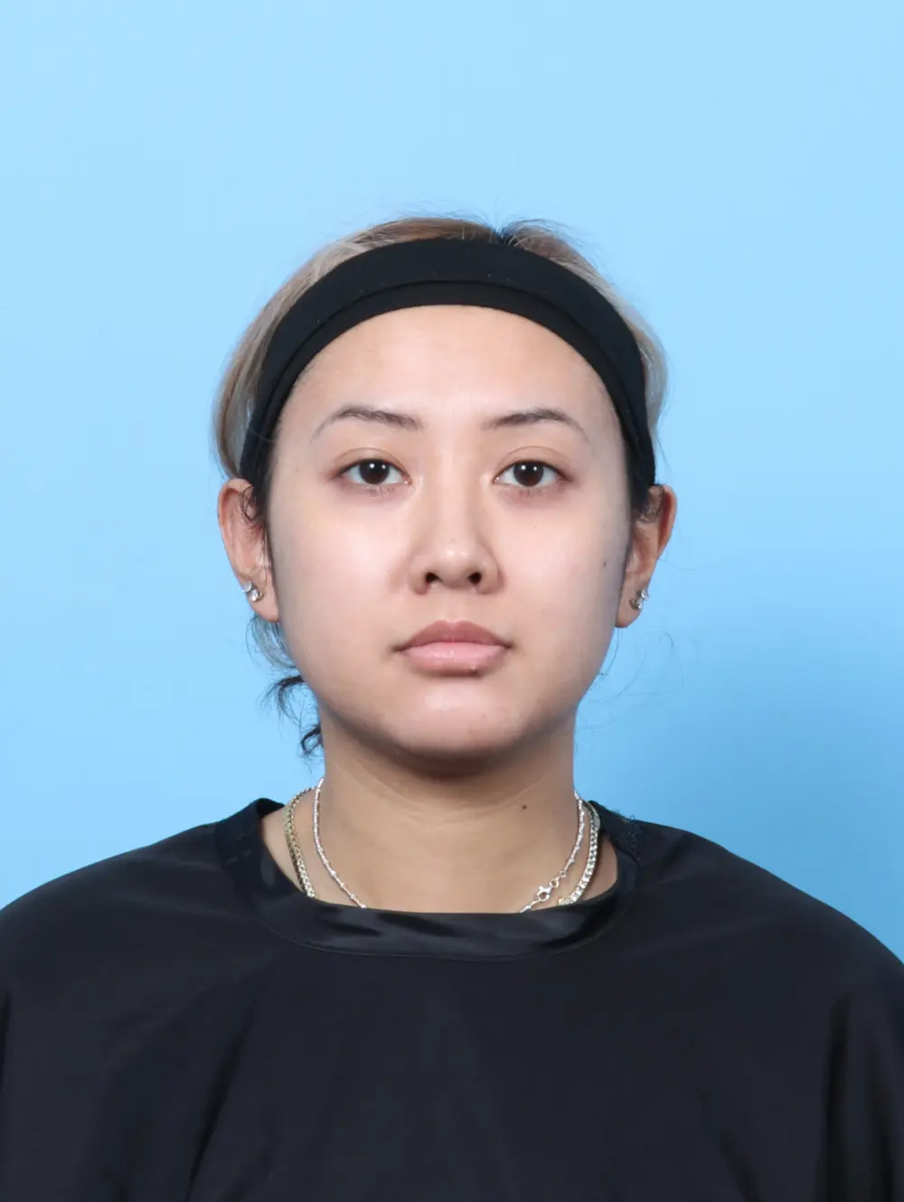 Rhinoplasty Patient Photo - Case 56656 - after view-2