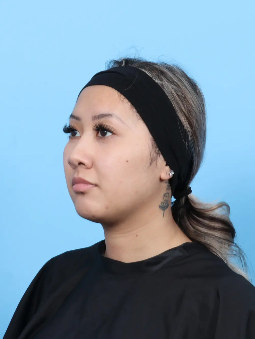 Rhinoplasty Patient Photo - Case 56656 - before view-1