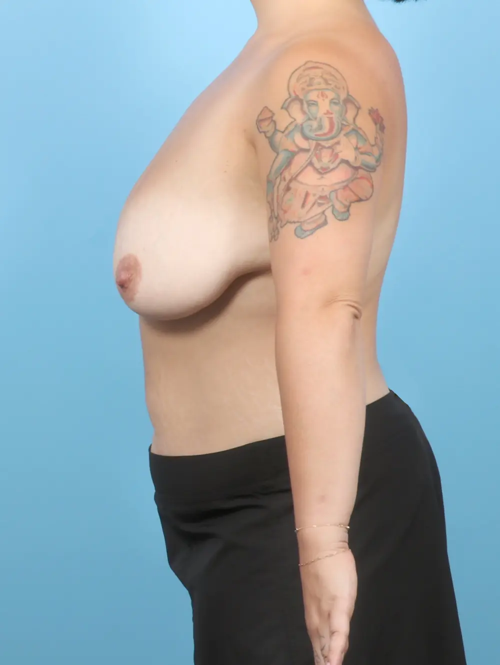 Breast Lift/Reduction w/o Implants Patient Photo - Case 56672 - before view-2