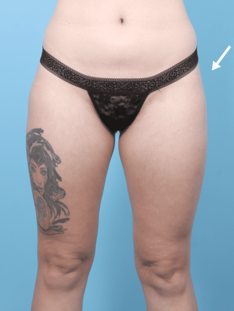 Fat Transfer - Case 56686 - After