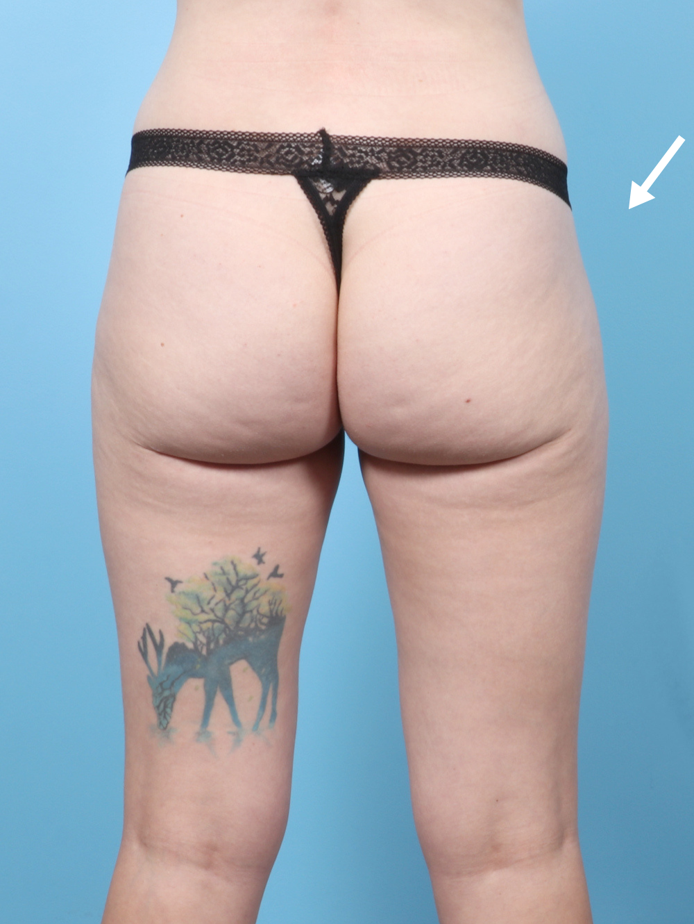 Fat Transfer Patient Photo - Case 56686 - after view-1