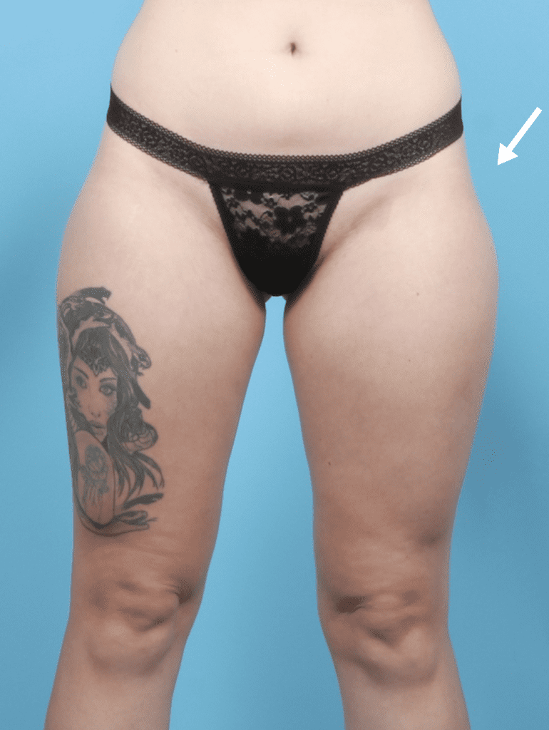 Fat Transfer - Case 56686 - Before