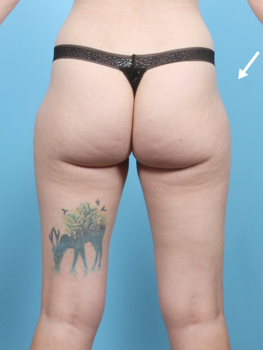 Fat Transfer Patient Photo - Case 56686 - before view-1