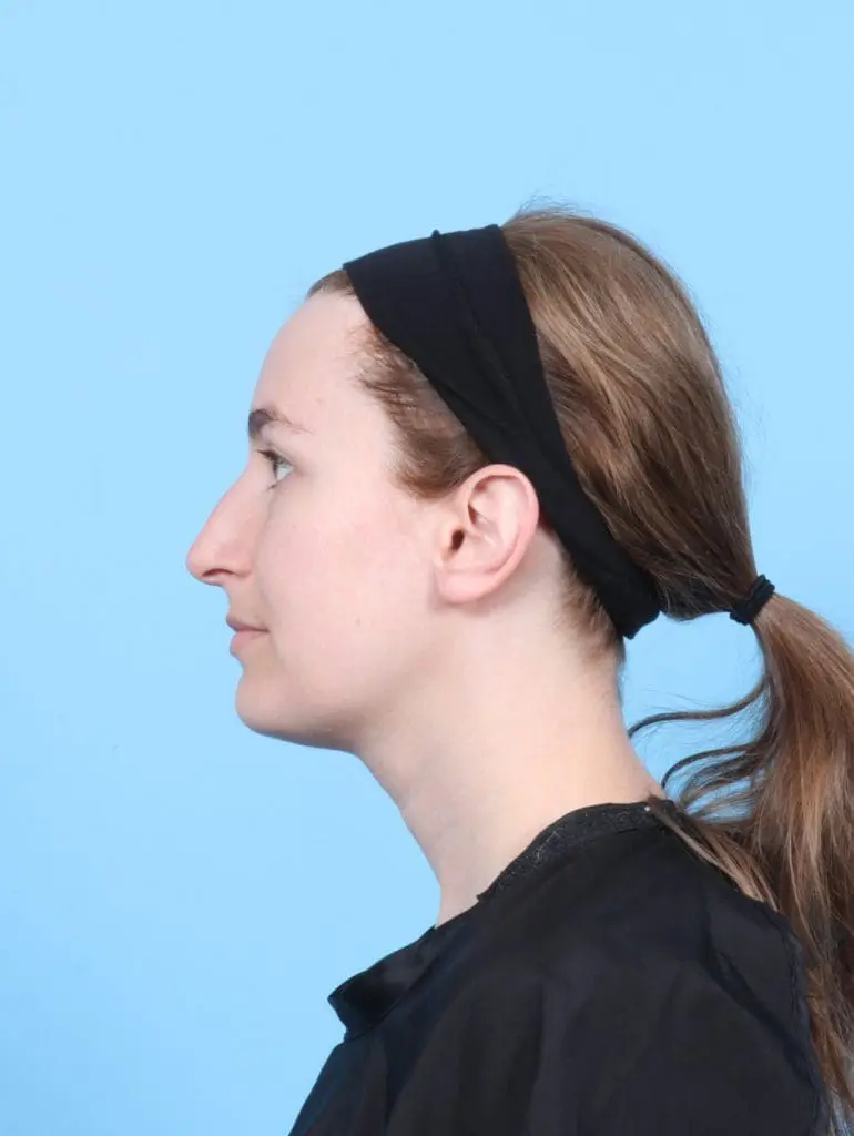 Rhinoplasty - Case 56692 - Before