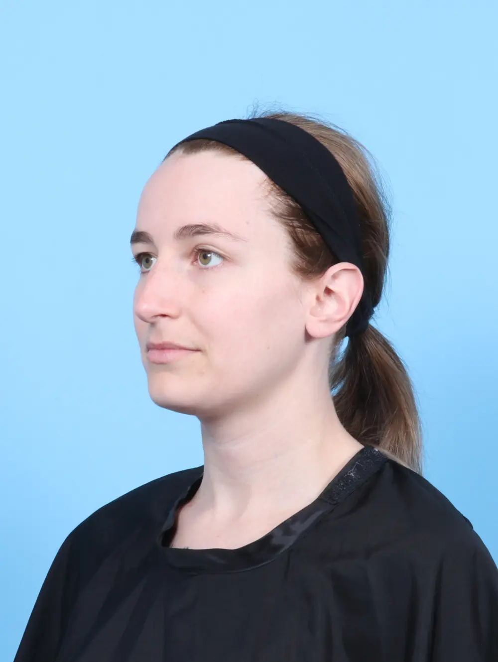 Rhinoplasty Patient Photo - Case 56692 - before view-1