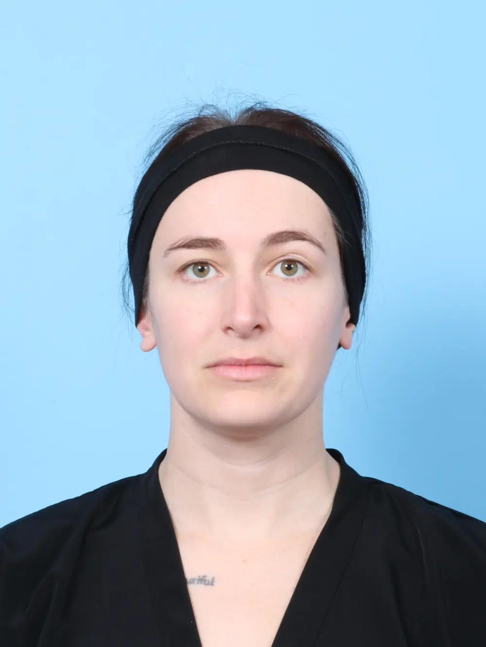 Rhinoplasty Patient Photo - Case 56692 - after view-2