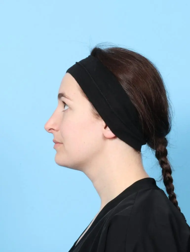 Rhinoplasty - Case 56692 - After