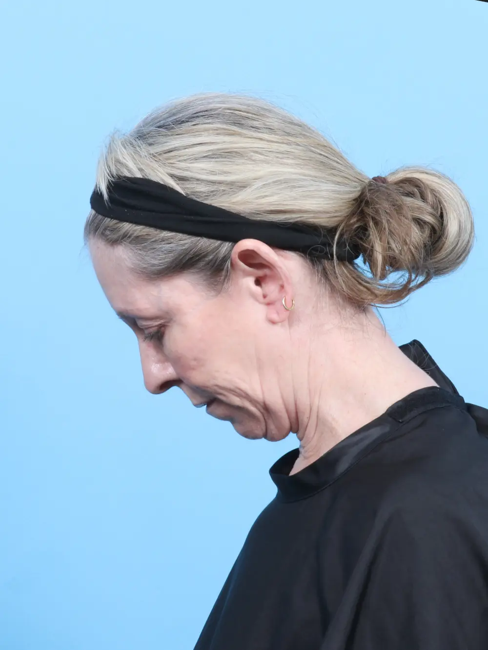 Eyelid Surgery Patient Photo - Case 56724 - before view-3