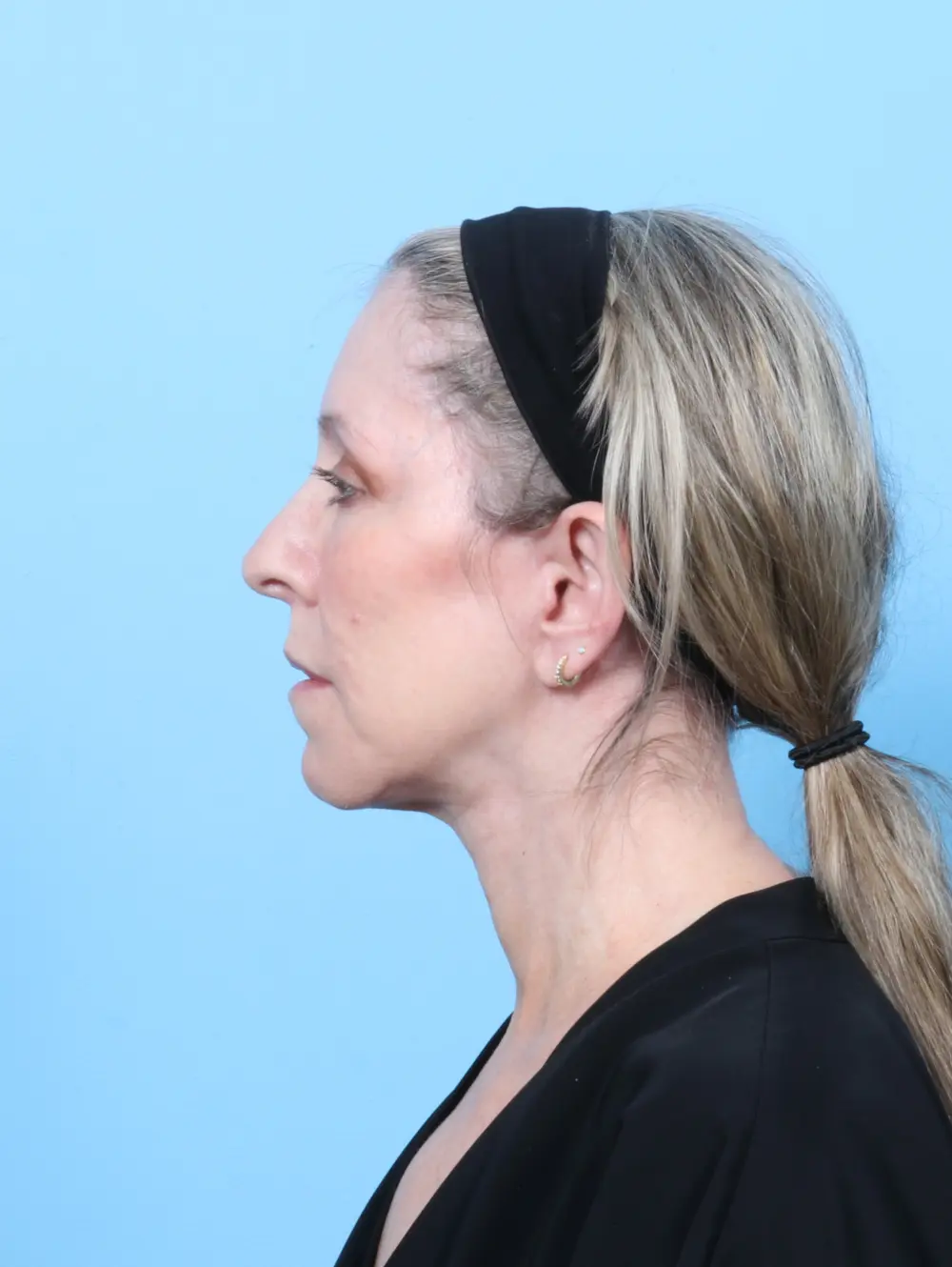 Eyelid Surgery Patient Photo - Case 56724 - after view-2