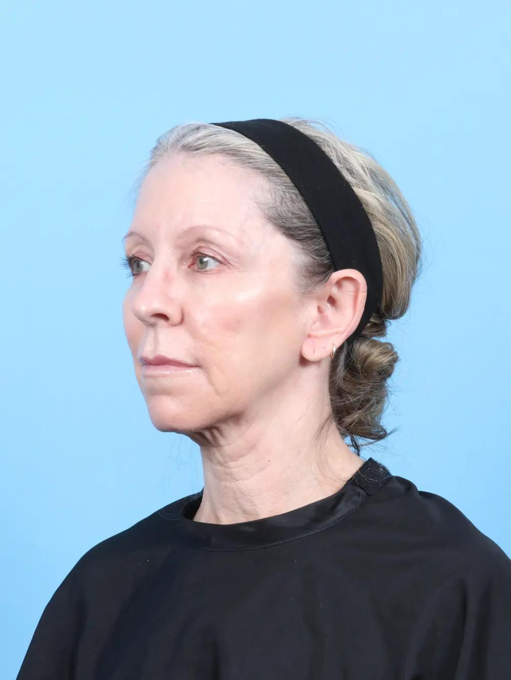 Eyelid Surgery Patient Photo - Case 56724 - before view-1