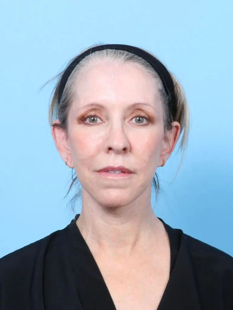 Eyelid Surgery - Case 56724 - After