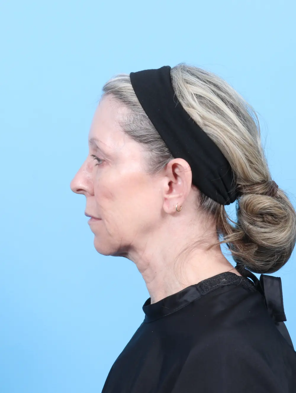 Eyelid Surgery Patient Photo - Case 56724 - before view-2