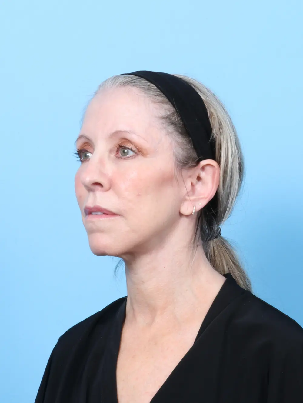 Eyelid Surgery Patient Photo - Case 56724 - after view-1