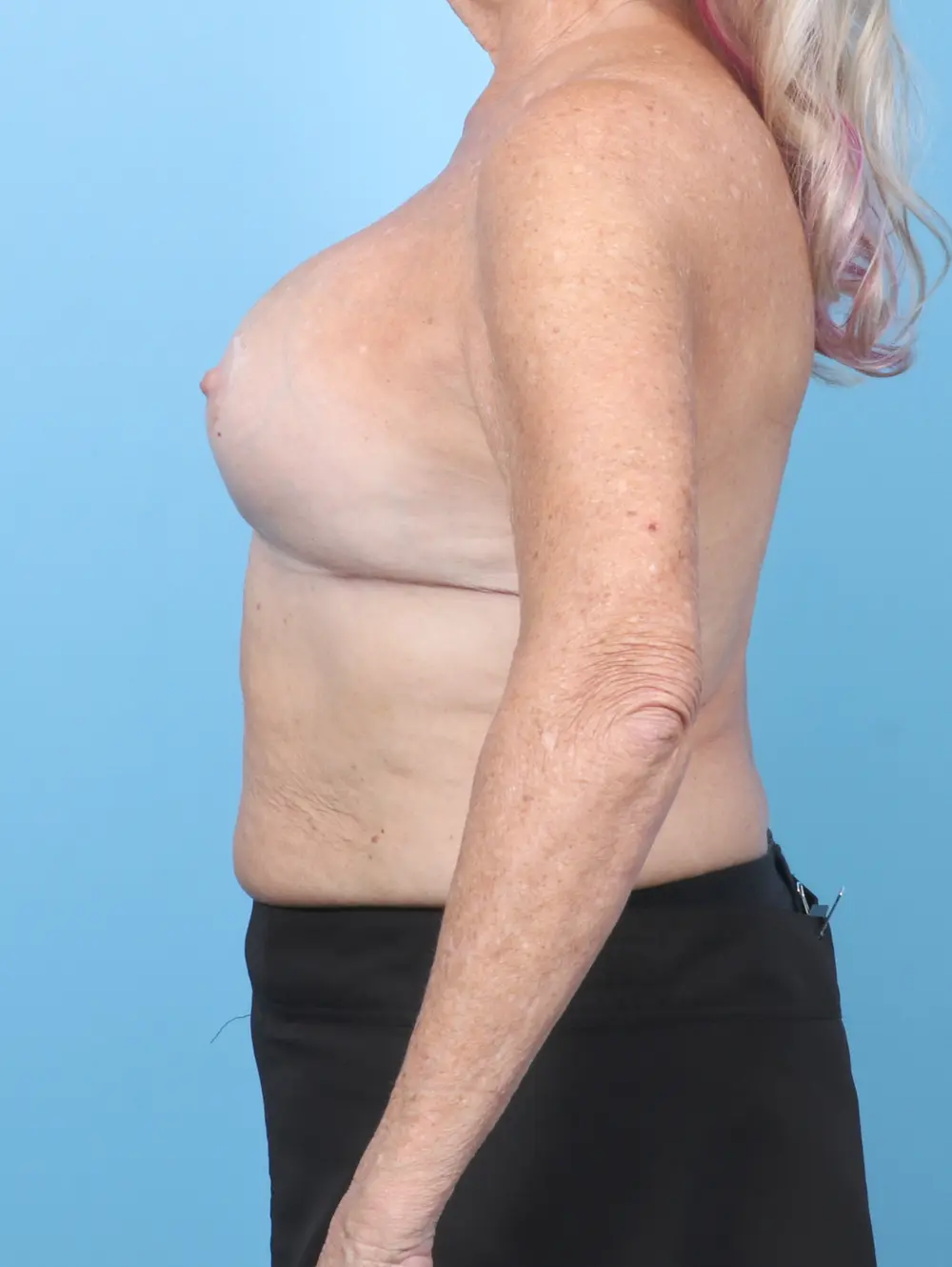 Breast Lift/Reduction with Implants Patient Photo - Case 56770 - after view-2