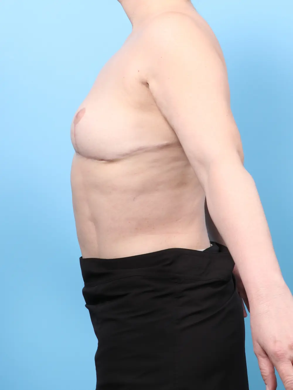 Breast Implant Removal Patient Photo - Case 56778 - after view-2