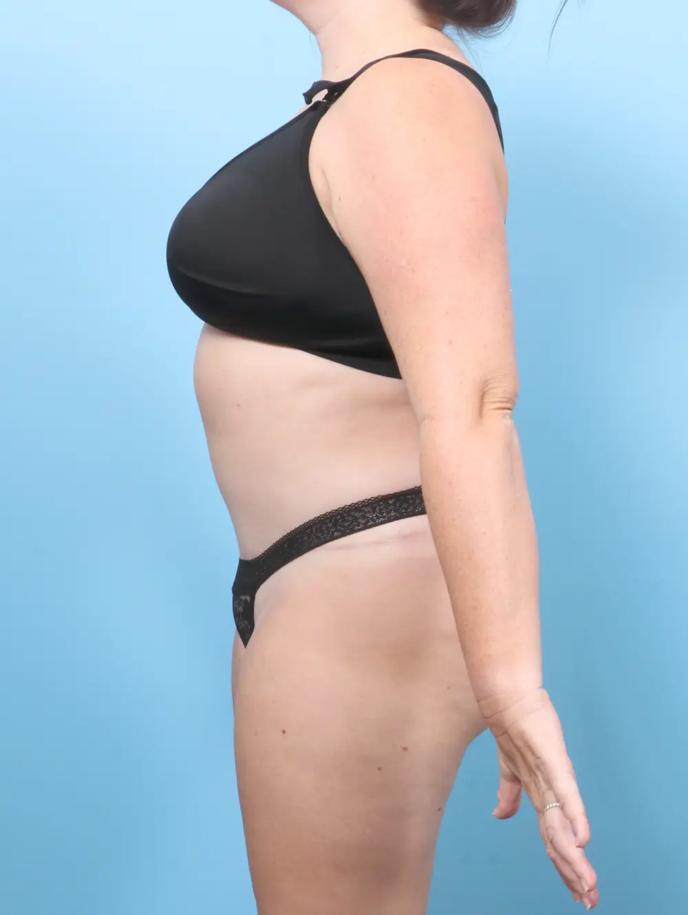 Tummy Tuck Patient Photo - Case 56808 - after view-2