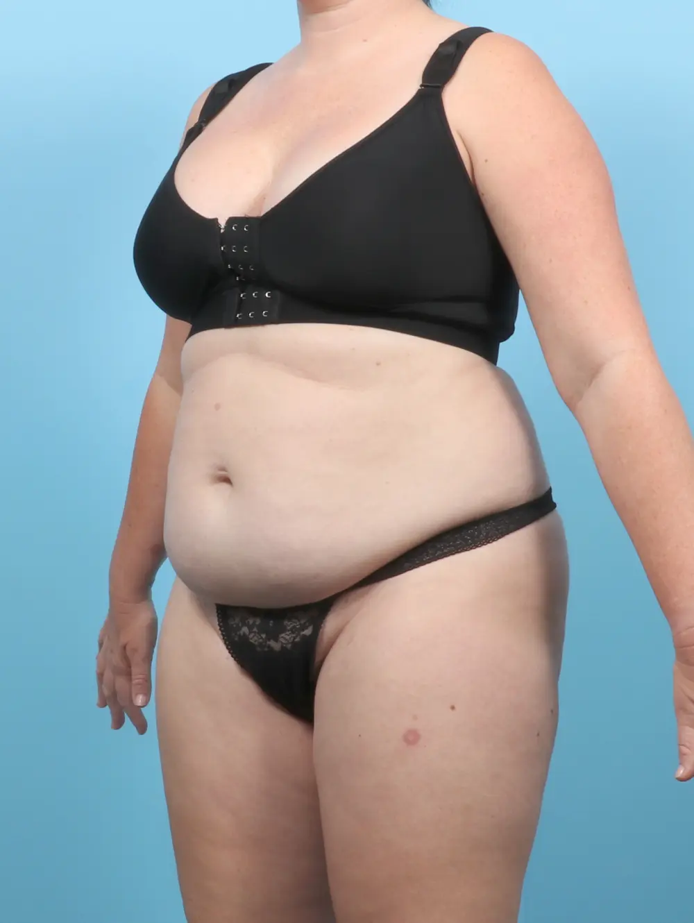Tummy Tuck Patient Photo - Case 56808 - before view-1