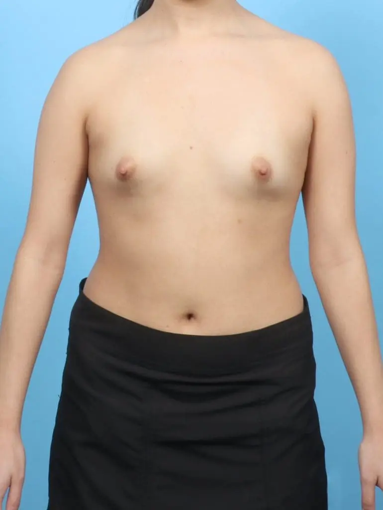 Breast Augmentation - Case 56818 - Before