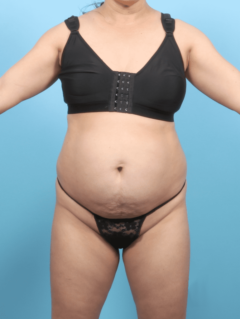 Tummy Tuck - Case 56835 - Before