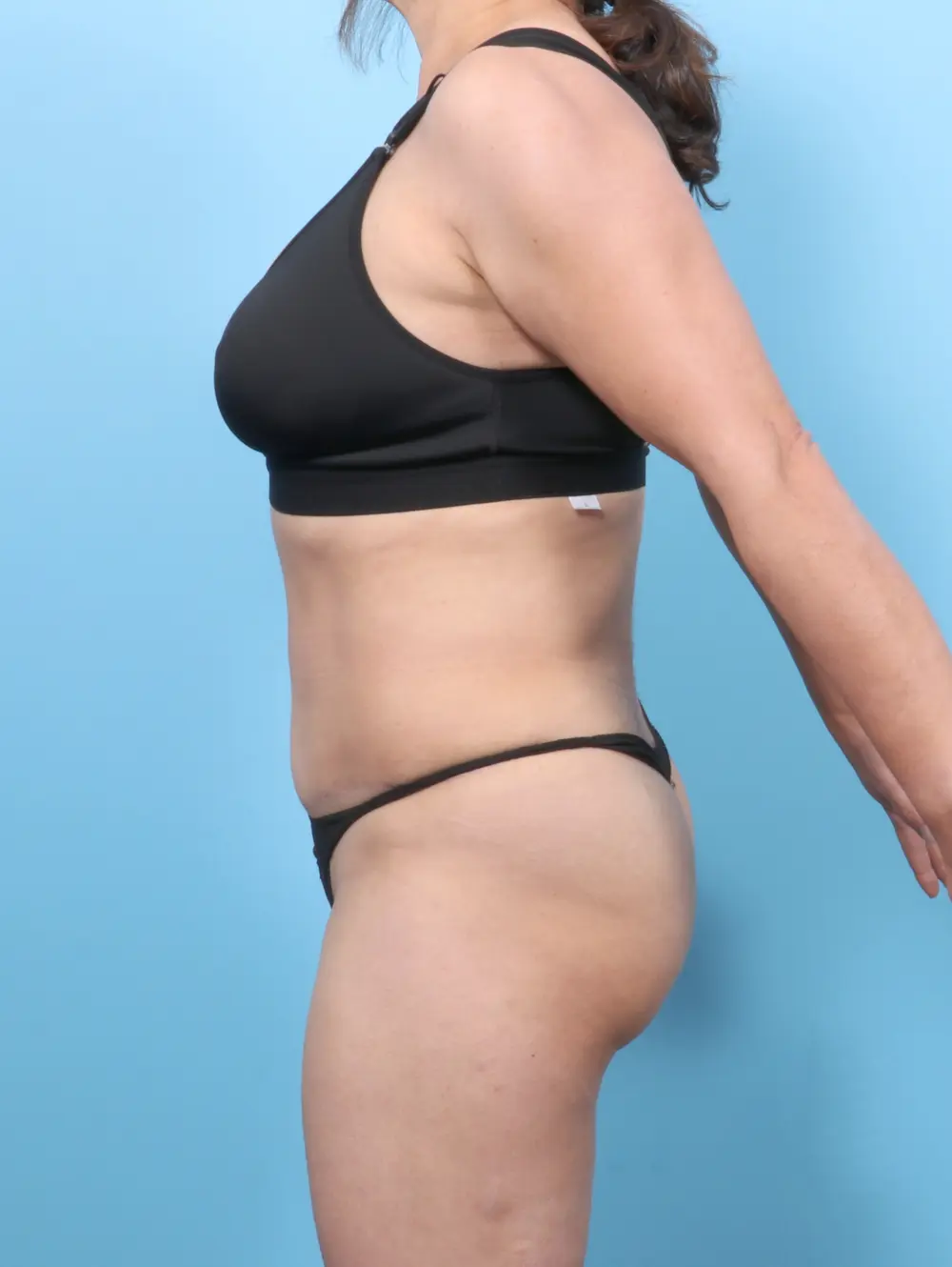 Tummy Tuck Patient Photo - Case 56835 - after view-2