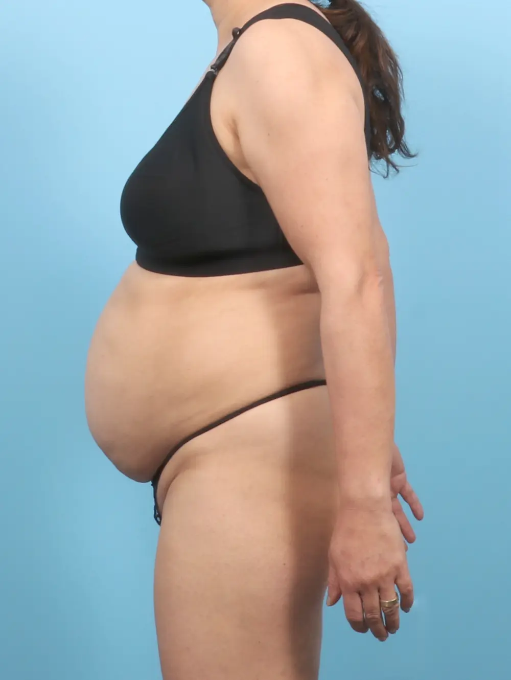 Tummy Tuck Patient Photo - Case 56835 - before view-2