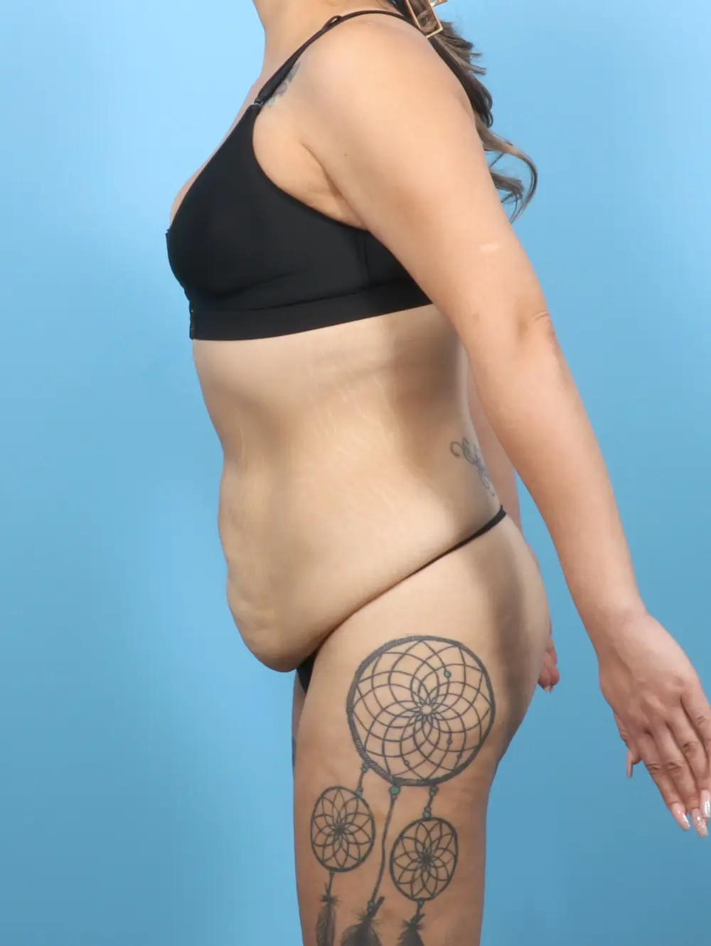 Tummy Tuck Patient Photo - Case 56952 - before view-2