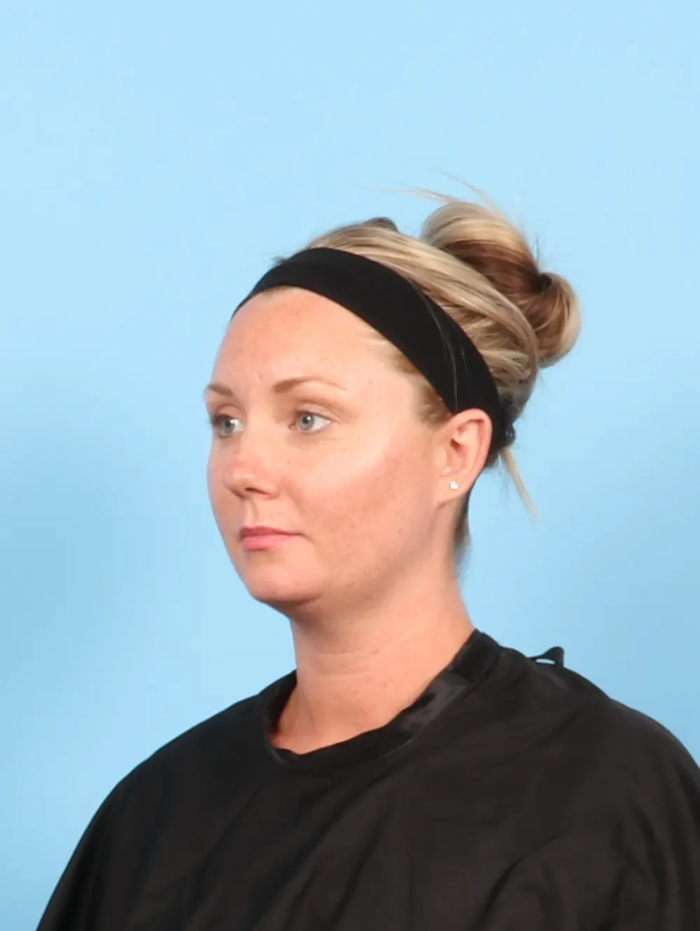 Anterior Neck Lift Patient Photo - Case 56962 - before view-1
