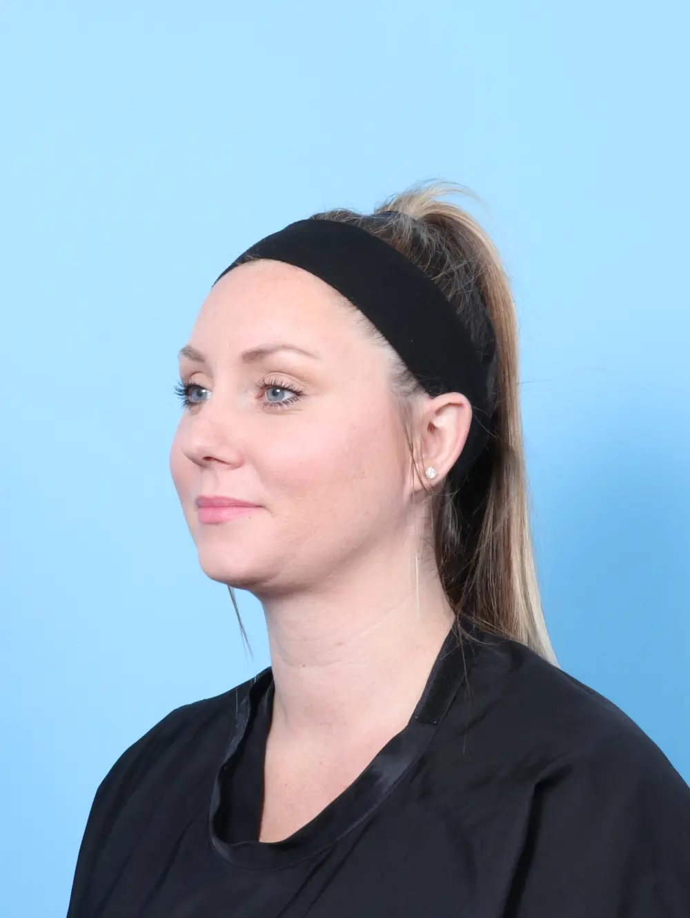 Anterior Neck Lift Patient Photo - Case 56962 - after view-1