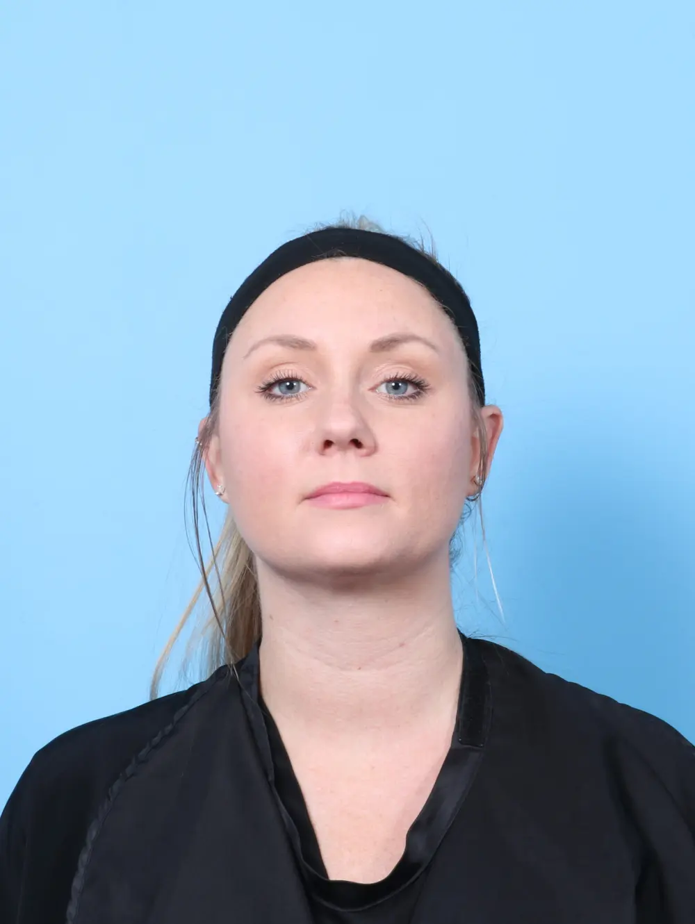 Anterior Neck Lift Patient Photo - Case 56962 - after view-2
