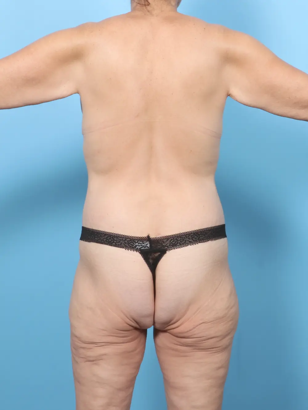 After Weight Loss Patient Photo - Case 57003 - after view-3